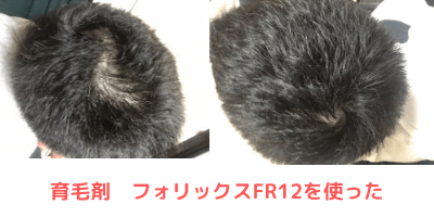 育毛剤フォリックスFR12,FR15,FR16
